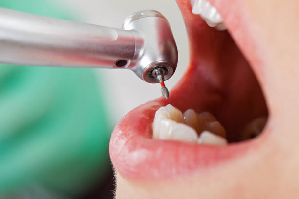 Best Emergency Wisdom Teeth Removal in Derwood, MD